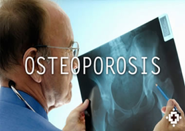 deficiency of vitamin D and Osteoporosis